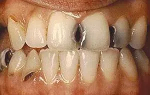 معلومات خاطئة حول تسوس الأسنان