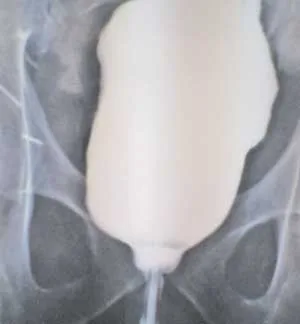 كفاءات طبية ليبية تجري‮ ‬عمليات مميزة بقسم جراحة المسالك البولية بمركز طرابلس الطبي ثلاث عمليات لتعويض مثانة مصابة بسرطان بمثانة جديدة من أمعاء المريض نفسه تمت بقسم جراحة المسالك البولية‮ ‬بمركز طرابلس الطبي