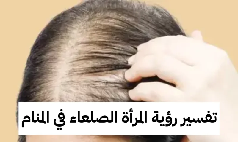 تفسير رؤية المرأة الصلعاء في المنام - دلالات ورمز حلم الصلع في الحلم لابن سيرين بالتفصيل