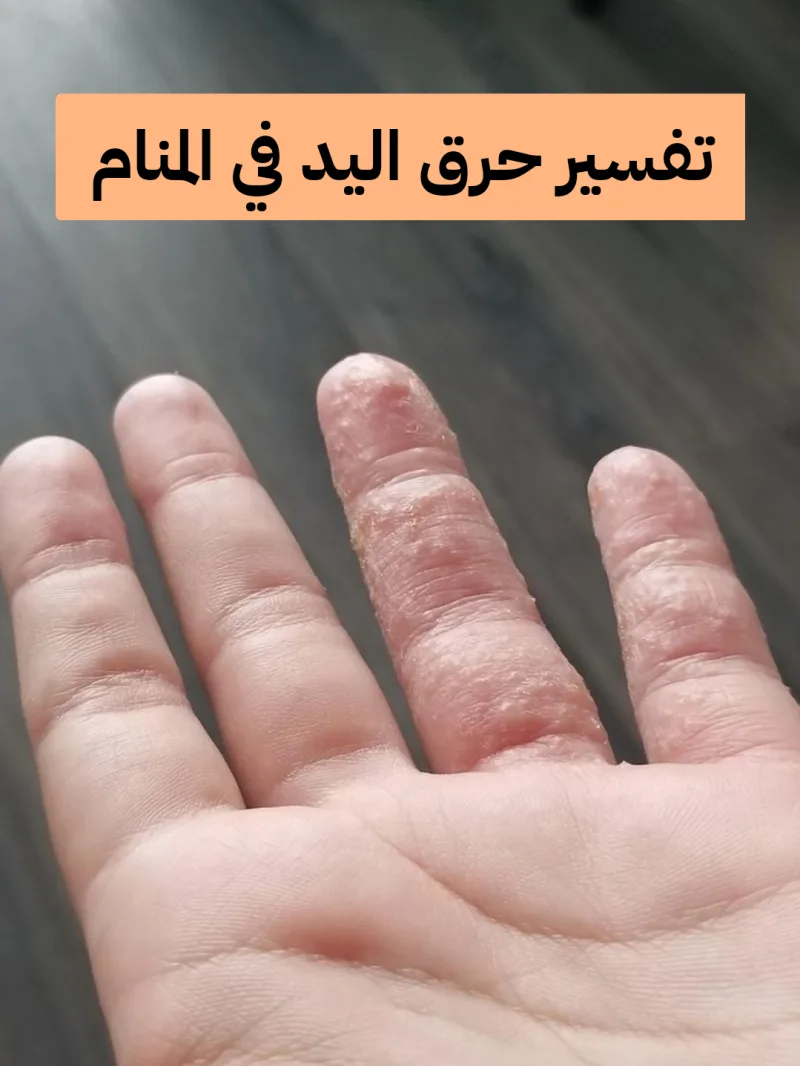 تفسير حرق اليد في المنام