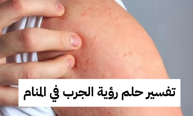 تفسير حلم رؤية الجرب في المنام بالتفصيل لابن سيرين