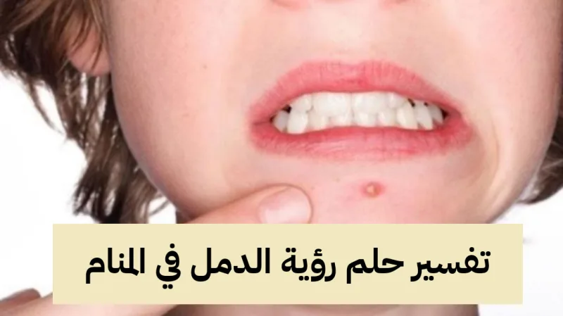 تفسير حلم رؤية الدمل في المنام