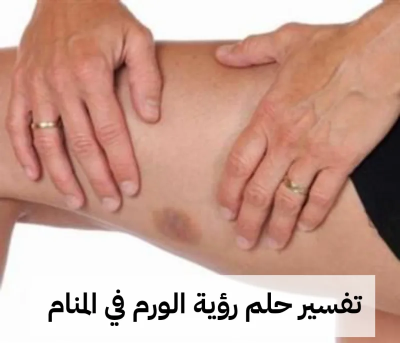 تفسير حلم رؤية الورم في المنام لابن سيرين بالتفصيل